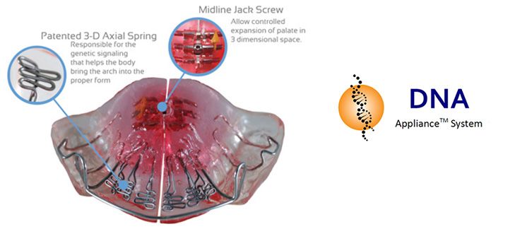 adult vivos orthodontic appliance 