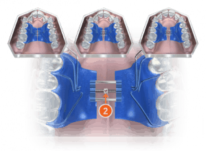 palate expander