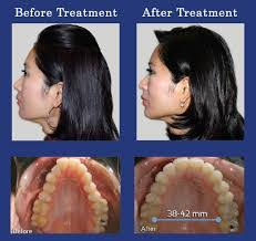 vivos dna appliance before and after