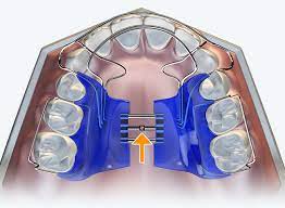 Biobloc Appliance