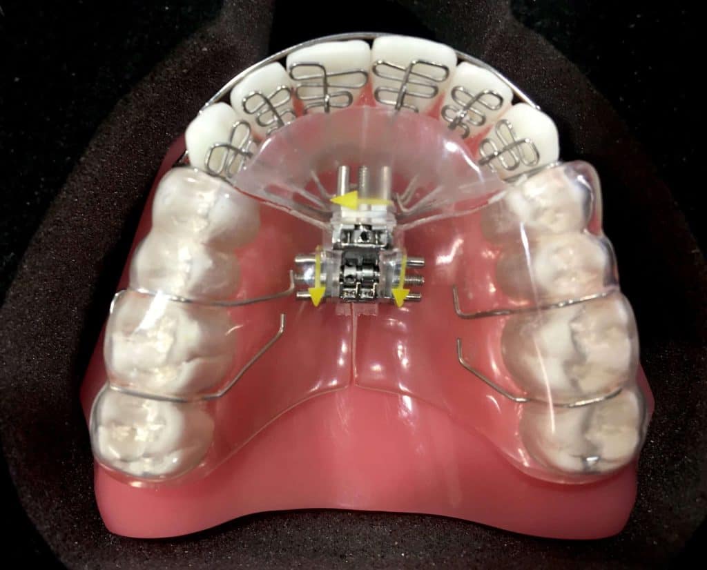 dna appliance teeth straightening