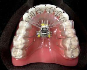 adult palatal expander