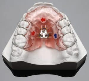 schwarz palatal expander