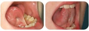 tongue tie release procedure