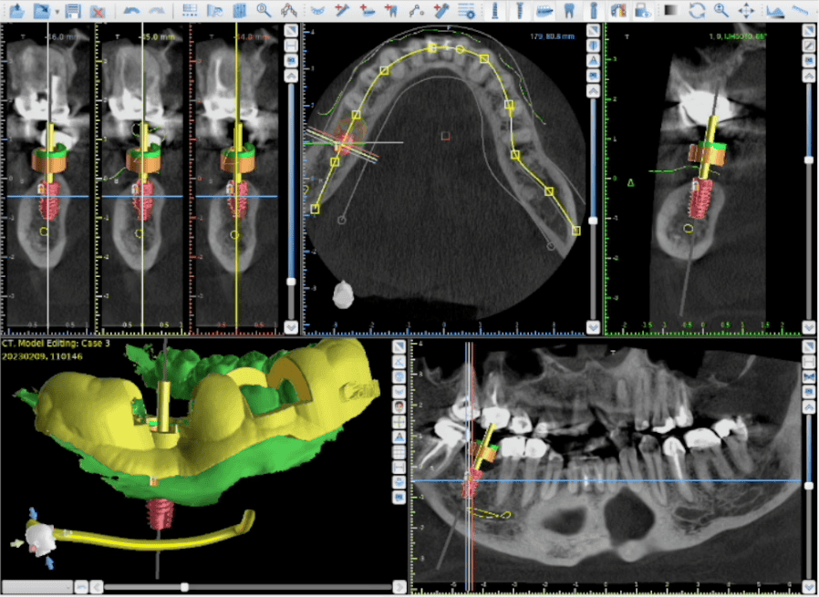 cbct cone beam root canal infection